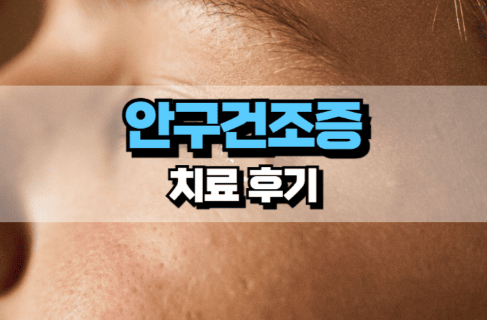 안구건조증-치료-후기-자가치료-썸네일